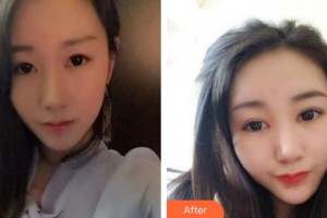 天門愛爾眼科醫(yī)院張新法整形價格表附眼部綜合案例展示