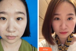 天門愛爾眼科醫(yī)院梁南進整形價格表附定點雙眼皮案例展示