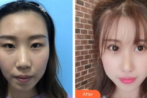 天門明保眼科醫(yī)院倪明保整形價格表附眼部綜合案例展示