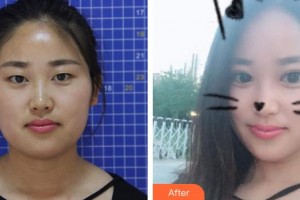 天門愛爾眼科醫(yī)院熊俊玲整形價格表附切開雙眼皮案例展示