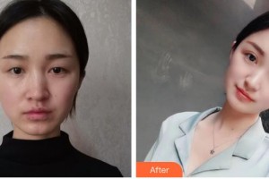 牡丹江王維群整形美容外科診所王維群整形價格表附眼部綜合案例展示