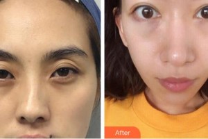 牡丹江鄒忠明整形美容外科診所鄒忠明 整形價格表附外切祛眼袋案例展示