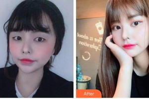 牡丹江北方醫(yī)院整形美容外科朱克文整形價格表附眼部綜合案例展示