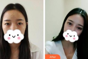 伊春市中心醫(yī)院燒傷整形外科黃耀斌整形價格表附眼部綜合案例展示