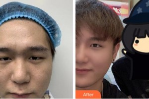 萍鄉(xiāng)漢和醫(yī)院美容整形中心唐家訓(xùn)整形價格表附開內(nèi)眼角案例展示