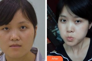 萍鄉(xiāng)優(yōu)美醫(yī)療美容門診部黎琳整形價格表附眼部綜合案例展示