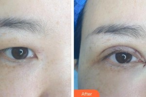 萍鄉(xiāng)優(yōu)美醫(yī)療美容門診部詹子慶整形價格表附眼部綜合案例展示