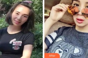 萍鄉(xiāng)薇尚醫(yī)療美容醫(yī)院夏清華整形價(jià)格表附激光美膚激光案例展示