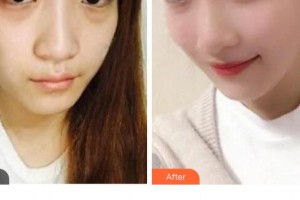 萍鄉(xiāng)百麗恒醫(yī)療美容診所廖云君整形價(jià)格表附埋線提升案例展示