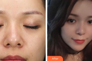 萍鄉(xiāng)百麗恒醫(yī)療美容診所徐應(yīng)胤整形價(jià)格表附熱拉提案例展示