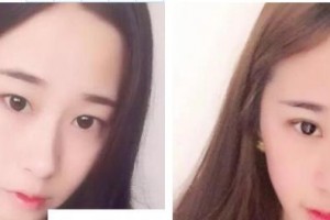 萍鄉(xiāng)愛(ài)爾眼科醫(yī)院李邦整形價(jià)格表附切開(kāi)雙眼皮案例展示