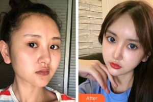 萍鄉(xiāng)愛爾眼科醫(yī)院劉松奇整形價格表附眼部綜合案例展示