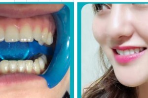 萍鄉(xiāng)龍琪口腔門(mén)診部龍琪整形價(jià)格表附冷光美白案例展示