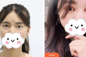 萍鄉(xiāng)市第二人民醫(yī)院眼科陳發(fā)春整形價(jià)格表附切開(kāi)雙眼皮案例展示