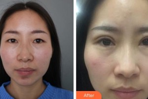 萍鄉(xiāng)市第二人民醫(yī)院眼科徐瓊整形價(jià)格表附切開(kāi)雙眼皮案例展示