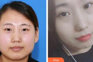 萍鄉(xiāng)市第二人民醫(yī)院眼科陳惠康整形價(jià)格表附切開(kāi)雙眼皮案例展示