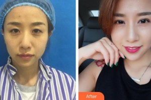 萍鄉(xiāng)市第二人民醫(yī)院眼科徐萍整形價(jià)格表附切開(kāi)雙眼皮案例展示