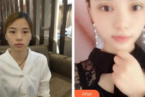 萍鄉(xiāng)薇尚醫(yī)療美容醫(yī)院沈洪元整形價(jià)格表附切開(kāi)雙眼皮案例展示