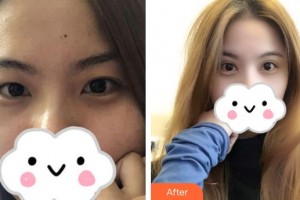 九江臺(tái)美整形美容醫(yī)院許言午整形價(jià)格表附切開(kāi)雙眼皮案例展示