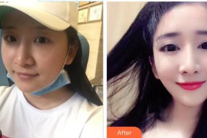 九江市第一人民醫(yī)院整形科宗艷霞整形價(jià)格表附切開(kāi)雙眼皮案例展示