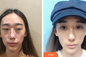 九江協(xié)和瑞美醫(yī)療美容門(mén)診部游鵬飛整形價(jià)格表附鼻部綜合案例展示