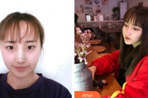 九江協(xié)和瑞美醫(yī)療美容門(mén)診部吳偉林整形價(jià)格表附鼻部綜合案例展示