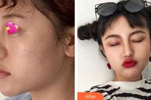 九江圣嘉麗醫(yī)療美容門(mén)診部樸濬整形價(jià)格表附鼻部綜合案例展示