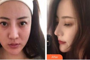 九江圣嘉麗醫(yī)療美容門(mén)診部胡南整形價(jià)格表附鼻修復(fù)案例展示