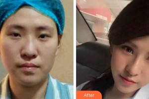 九江圣嘉麗醫(yī)療美容門(mén)診部高鵬整形價(jià)格表附膨體隆鼻案例展示