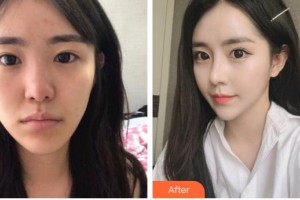 九江學(xué)院附屬醫(yī)院整形美容科詹太國(guó)整形價(jià)格表附鼻部綜合案例展示