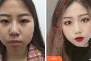 九江風(fēng)華醫(yī)療美容門診部黃健生整形價(jià)格表附假體隆鼻案例展示