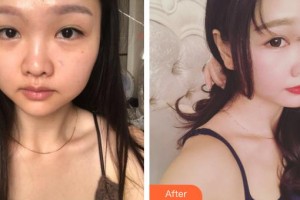 九江瑞麗醫(yī)療美容醫(yī)院萬(wàn)成整形價(jià)格表附肋軟骨隆鼻案例展示