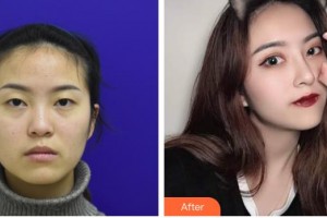 九江唯美醫(yī)療美容門診部胡君整形價(jià)格表附鼻翼縮小案例展示