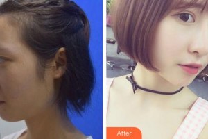 九江市中醫(yī)醫(yī)院眼科余杰為整形價(jià)格表附鼻部綜合案例展示