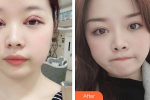 九江愛(ài)爾中山眼科醫(yī)院高崇惠整形價(jià)格表附切開(kāi)雙眼皮案例展示