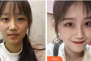 九江愛(ài)爾中山眼科醫(yī)院李紅鳴整形價(jià)格表附切開(kāi)雙眼皮案例展示