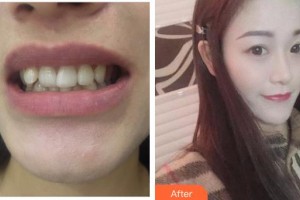 九江奇洋口腔門診部吳揚(yáng)整形價(jià)格表附牙齒隱形矯正案例展示