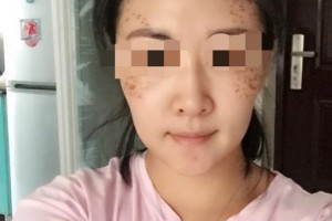 贛州明珠麗格醫(yī)療美容醫(yī)院陳巖青整形價(jià)格表附埋線提升案例展示