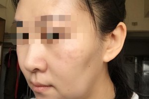 贛州華美醫(yī)療美容門診部馬金萍整形價(jià)格表附埋線提升案例展示