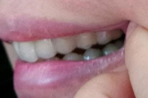 贛州維樂口腔門診部劉俊莉整形價(jià)格表附牙綜合案例展示