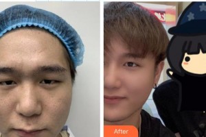 宜春學(xué)院整形美容醫(yī)院周金娟整形價格表附開內(nèi)眼角案例展示