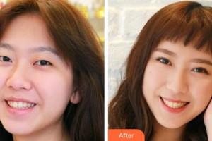 宜春學(xué)院整形美容醫(yī)院曹寒秀整形價格表附切開雙眼皮案例展示