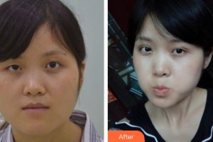 宜春學(xué)院整形美容醫(yī)院劉劍整形價格表附眼部綜合案例展示