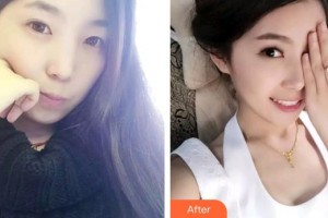 宜春學(xué)院整形美容醫(yī)院陳翼整形價格表附牙齒隱形矯正案例展示