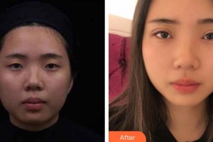 宜春天澤美容醫(yī)院彭銀全整形價(jià)格表附眼部綜合案例展示