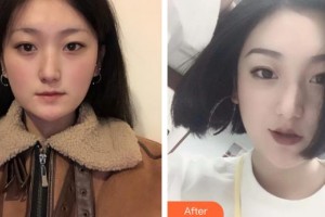 宜春愛爾眼科醫(yī)院張忠勝整形價格表附定點雙眼皮案例展示