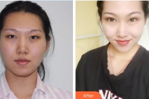 宜春愛爾眼科醫(yī)院周益龍整形價格表附眼部綜合案例展示