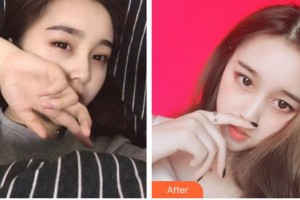 宜春愛爾眼科醫(yī)院鄢濤整形價格表附眼部綜合案例展示