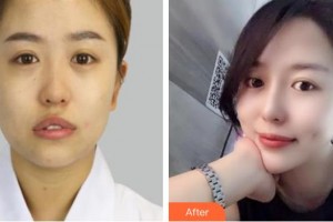 撫州江醫(yī)生醫(yī)療美容門診部江娟萍整形價(jià)格表附眼部修復(fù)案例展示