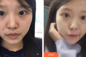 撫州美萊爾醫(yī)療美容門診部斯樓斌整形價(jià)格表附切開雙眼皮案例展示